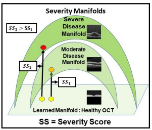 Gradient-Based Severity Labeling for OCT Biomarker Classification